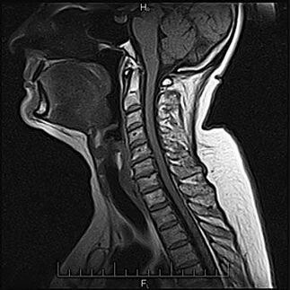 a nyaki osteochondrosis diagnózisa