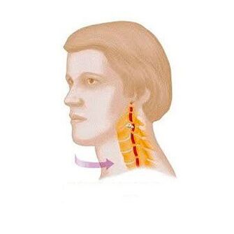 csigolya szindróma nyaki osteochondrosisral