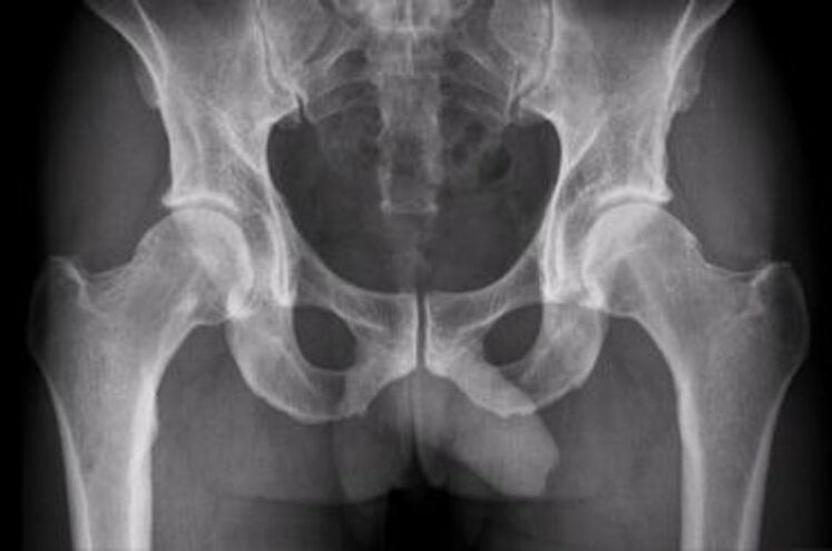 a csípőízület röntgenfelvétele fájdalomra