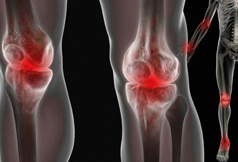 Különböző betegségek okozta fájdalom a karok és lábak ízületeiben