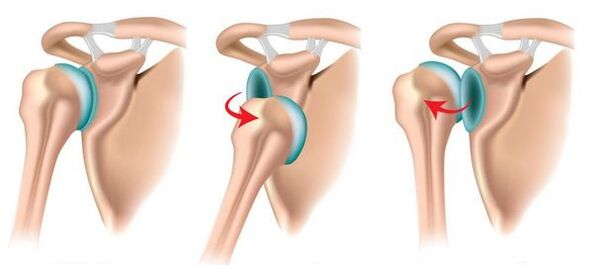 A vállízület elülső és hátsó diszlokációja, amely az arthrosis kialakulását provokálja
