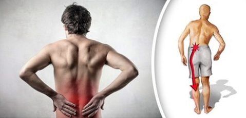 Az ágyéki osteochondrosis fájdalom szindróma a lábakra sugárzik