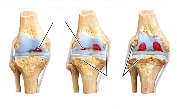a térd arthrosis szakaszai