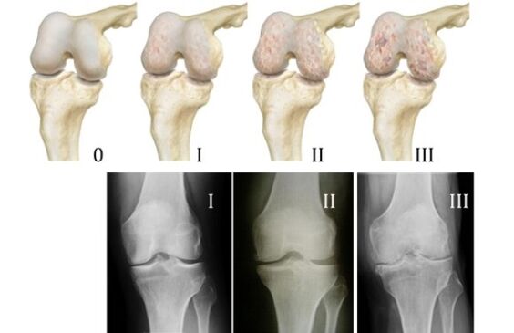 módszerek a térd arthrosis diagnosztizálására